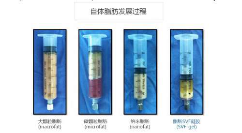 陈滔医生：SVF脂肪baby胶 新技术让脂肪变废为宝