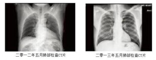 患了肺部疾病，被西医“判了死刑”？-请到这里来扁康